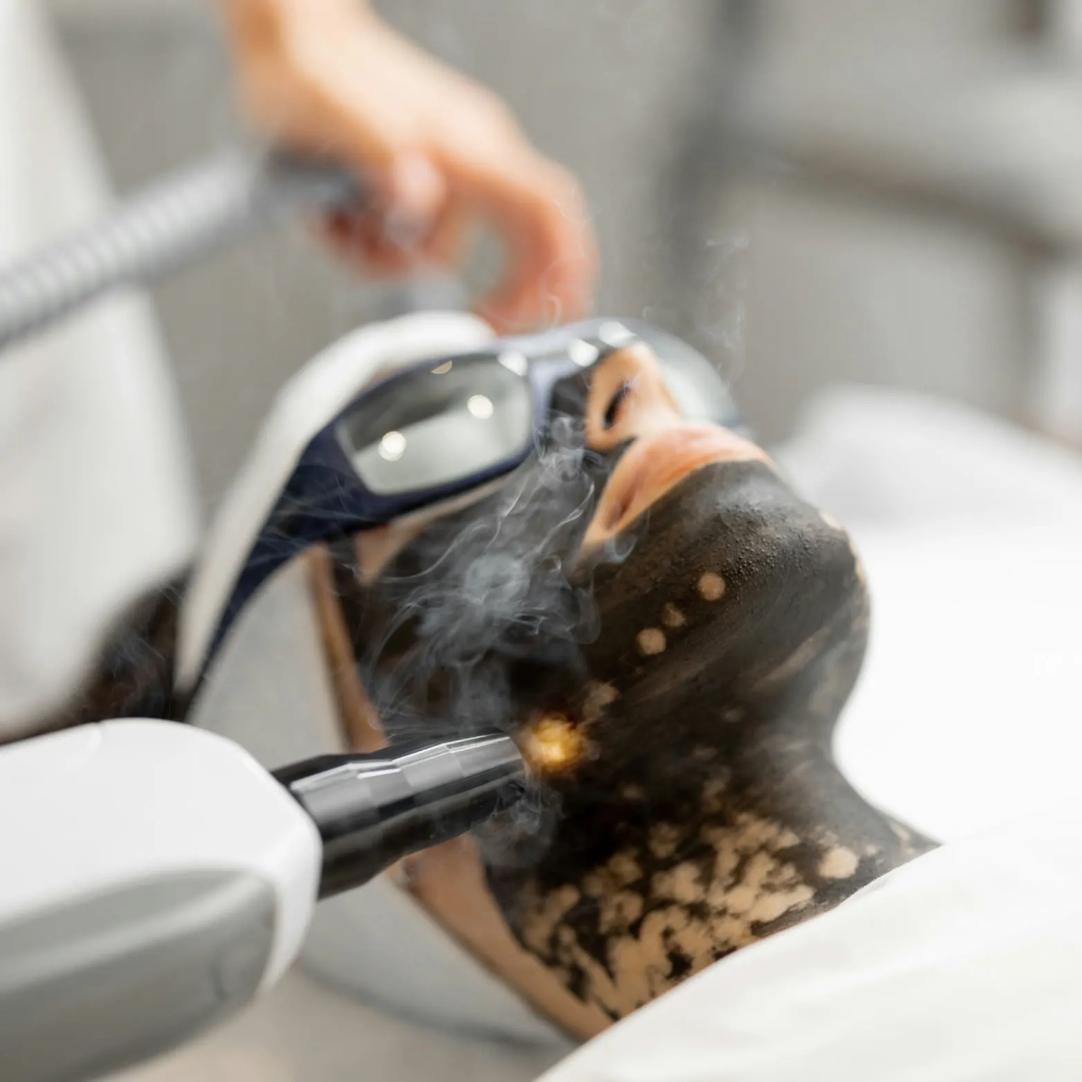 Sesión de Carbon Peel con láser Q-Switched y gafas de protección